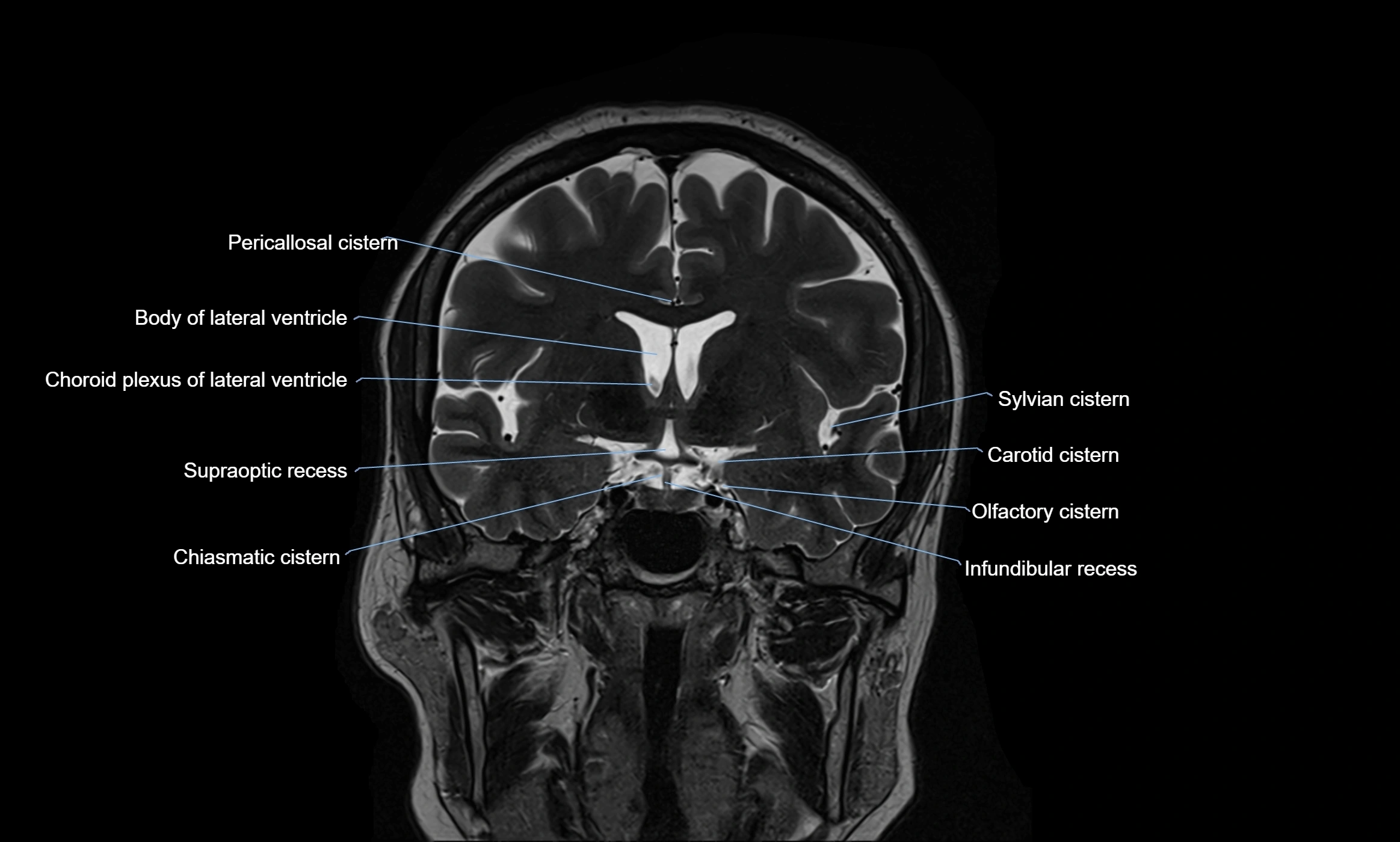 Brain cisterns  and ventricles coronal anatomy 3T MRI image-img-00001-00023.webp
